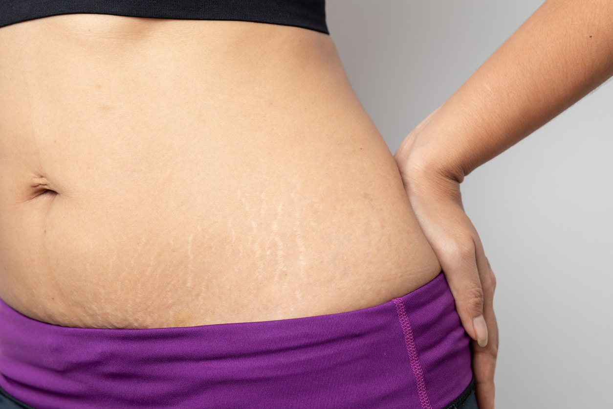 tummy-tuck-for-stretch-marks-blog-tampa-bay-aesthetic